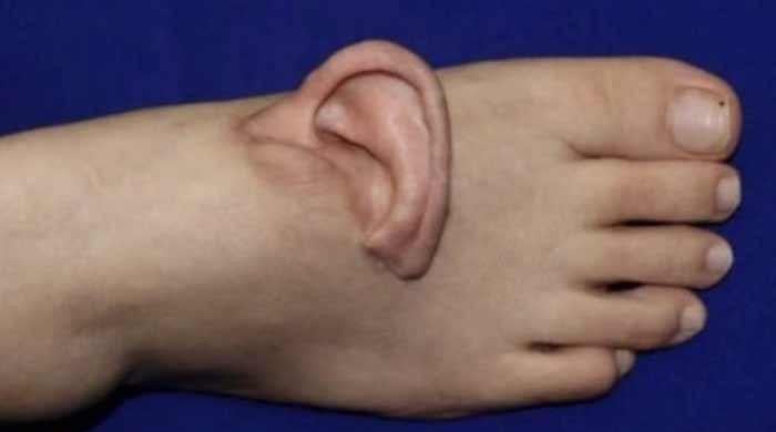 Chinese surgeons attach woman’s torn ear to foot after accident